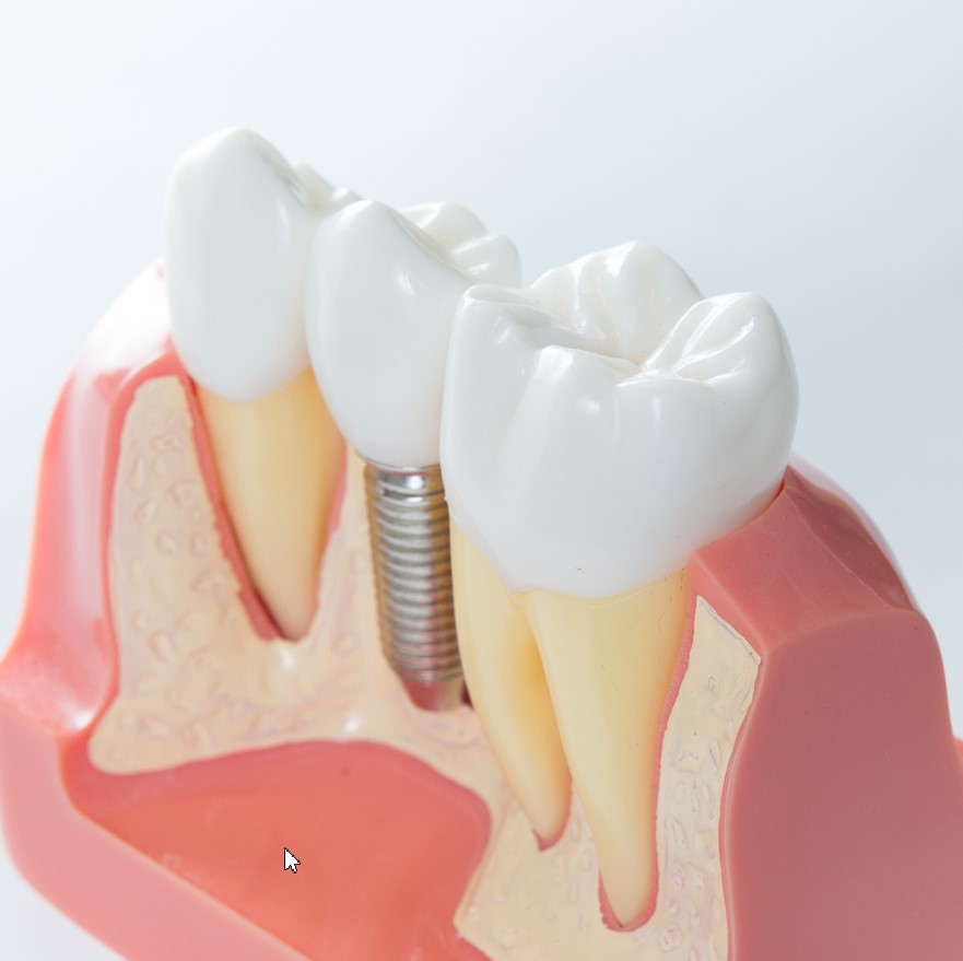 cost of dental implant